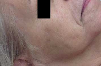 Avant traitement lumecca.