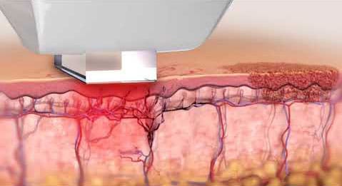 Traitement de l'epiderme.