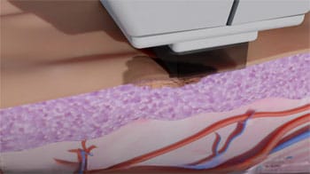 Traitement bbl-hero.