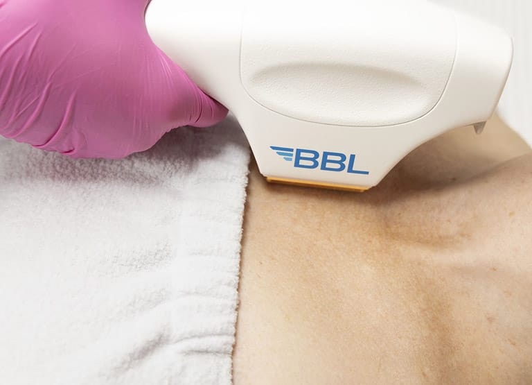 Traitement a l'aide de l'appareil BBL.