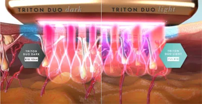 Effets du triton.