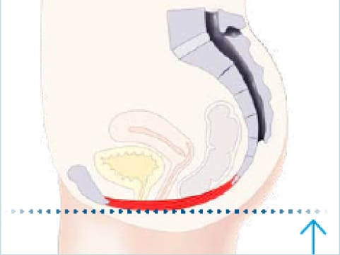 Image apres le traitement emsella.