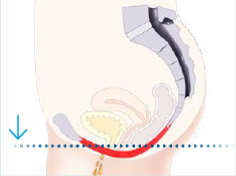 Image avant le traitement emsella.