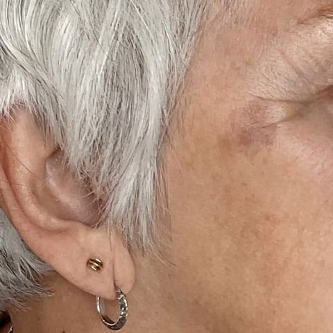 Resultat apres traitement lumecca peak.